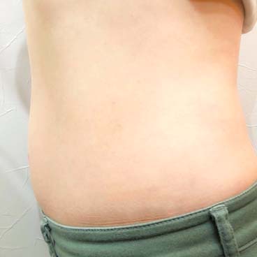 脂肪冷却ダイエット後(側面) | i-salon