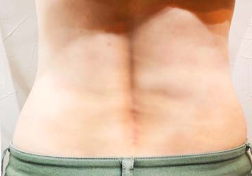 脂肪冷却ダイエット後(背中) | i-salon