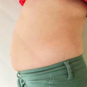 脂肪冷却ダイエット前(側面) | i-salon