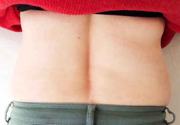 脂肪冷却ダイエット前(背中) | i-salon